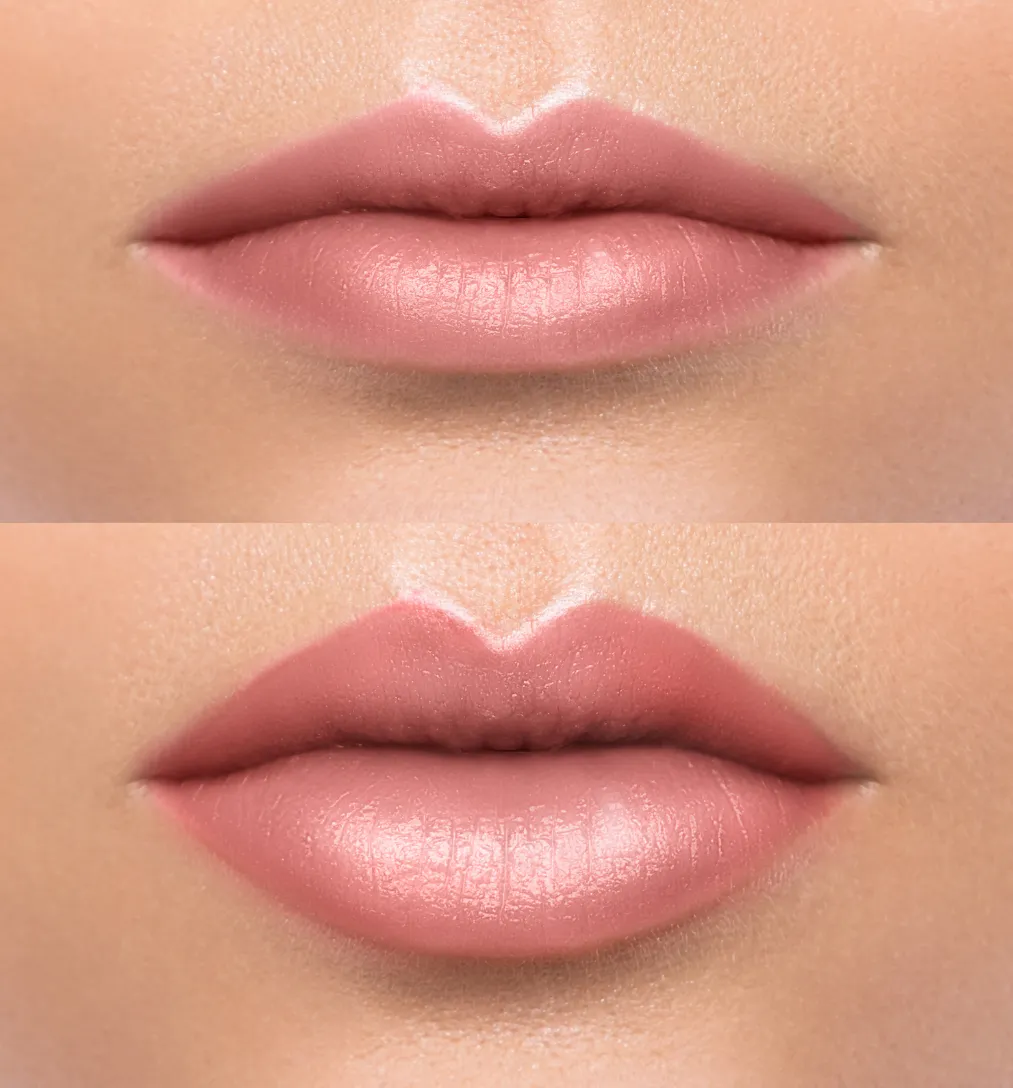 Aumento_de_labios-1364941